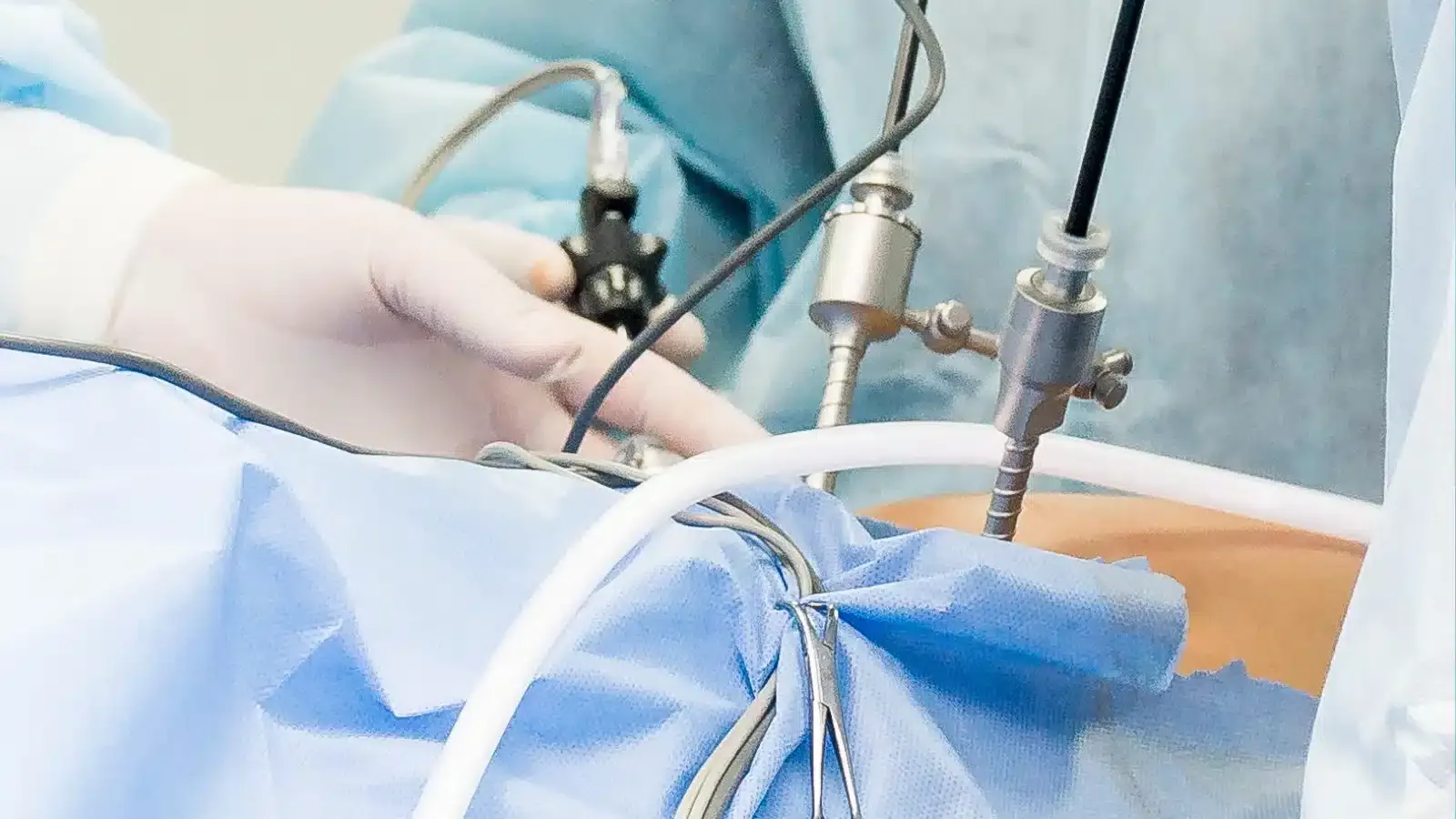 Laparoscopic-Hernia treatment