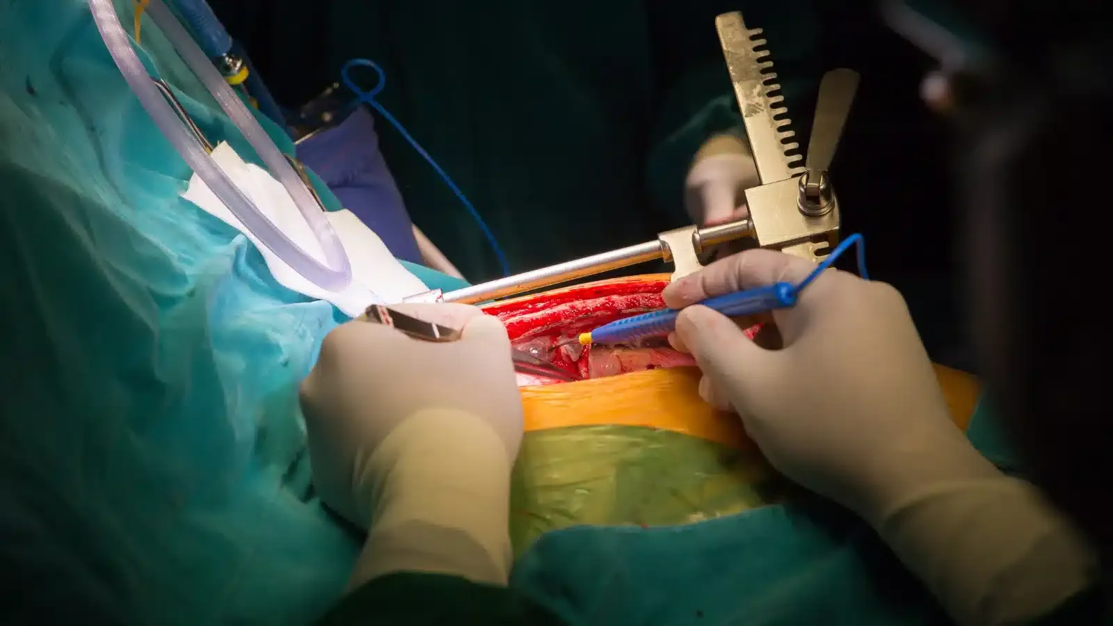 hip replacment
