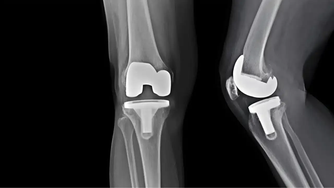 total knee replacement