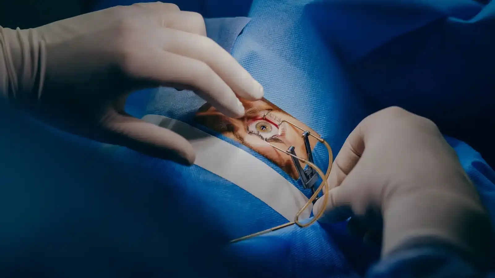 cornea transplant surgery