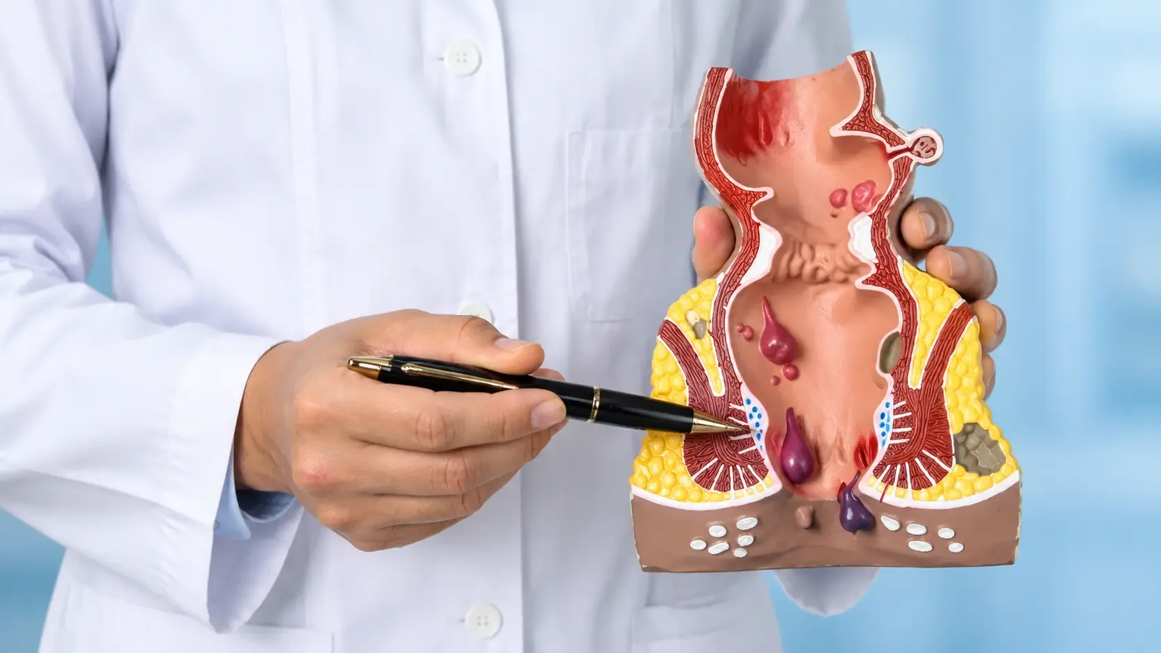 Doctor explaining piles (hemorrhoids) using an anatomical model of the rectum and anal canal.