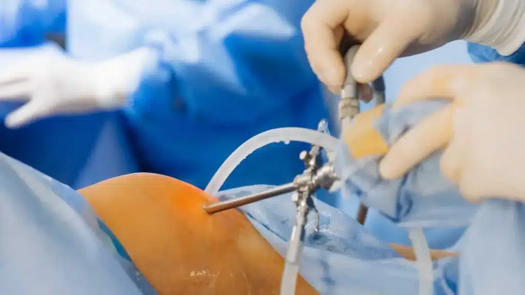 Laparoscopic-Fundoplication treatment